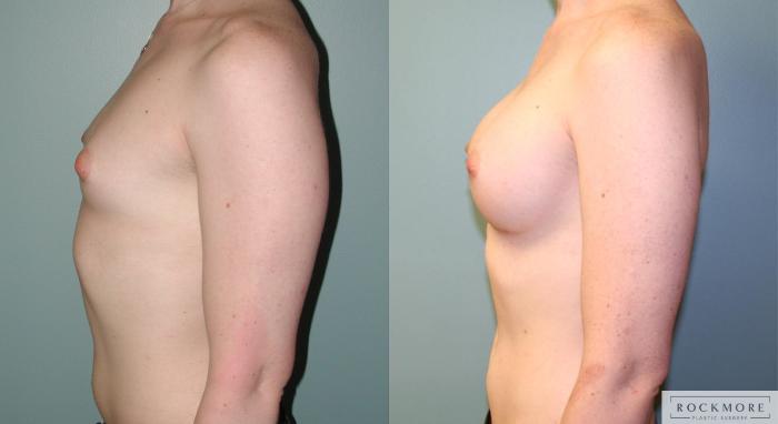 Before & After Gender Transformation MTF Case 177 View #5 View in Albany & Latham, New York