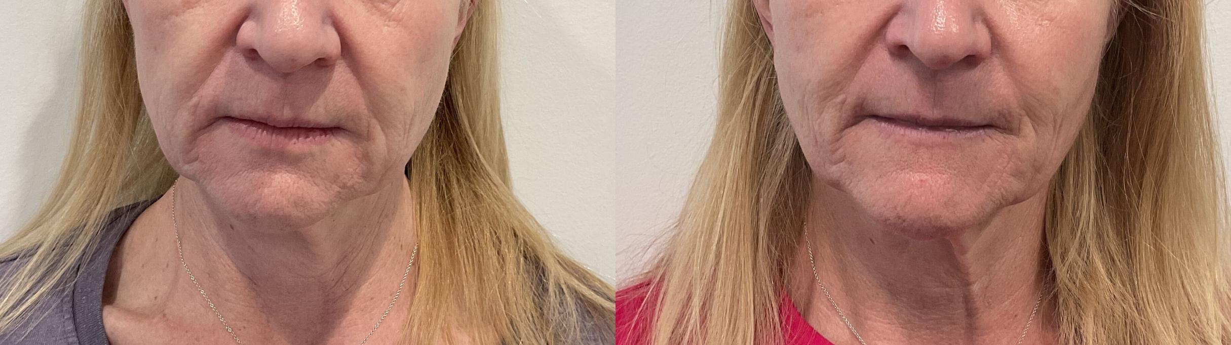 Before & After Helix CO2 Laser Case 478 Front View in Albany, Latham & Saratoga, New York