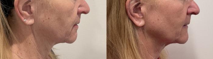 Before & After Helix CO2 Laser Case 478 Right Side View in Albany, Latham & Saratoga, New York