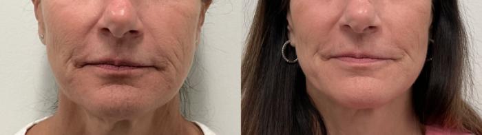 Before & After Helix CO2 Laser Case 490 Front View in Albany, Latham & Saratoga, New York