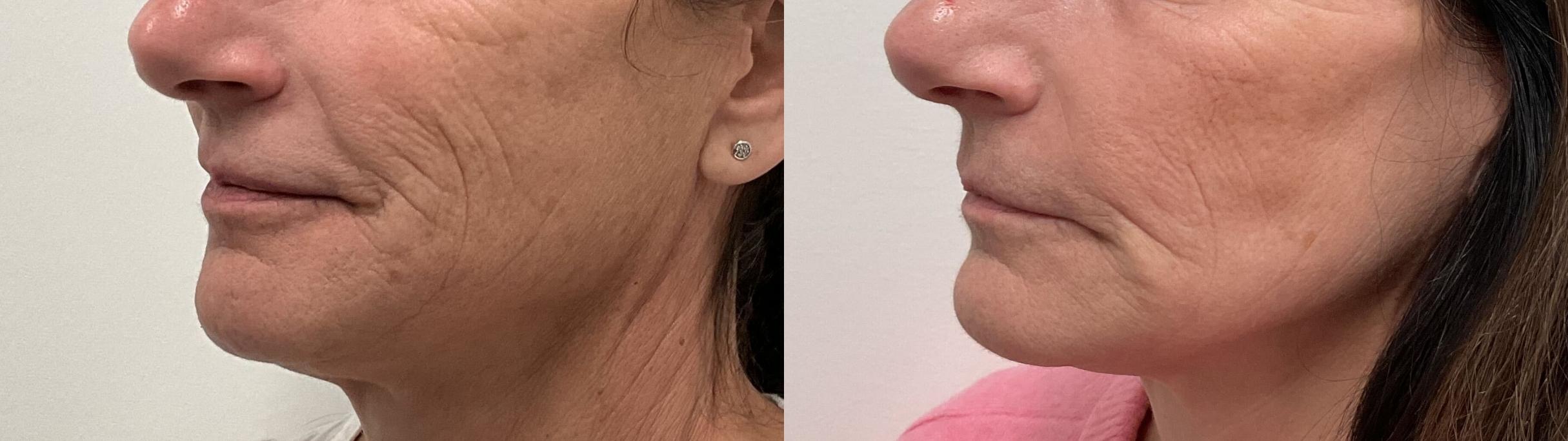 Before & After Helix CO2 Laser Case 490 Left Oblique View in Albany, Latham & Saratoga, New York
