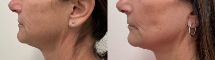 Before & After Helix CO2 Laser Case 490 Left Side View in Albany, Latham & Saratoga, New York