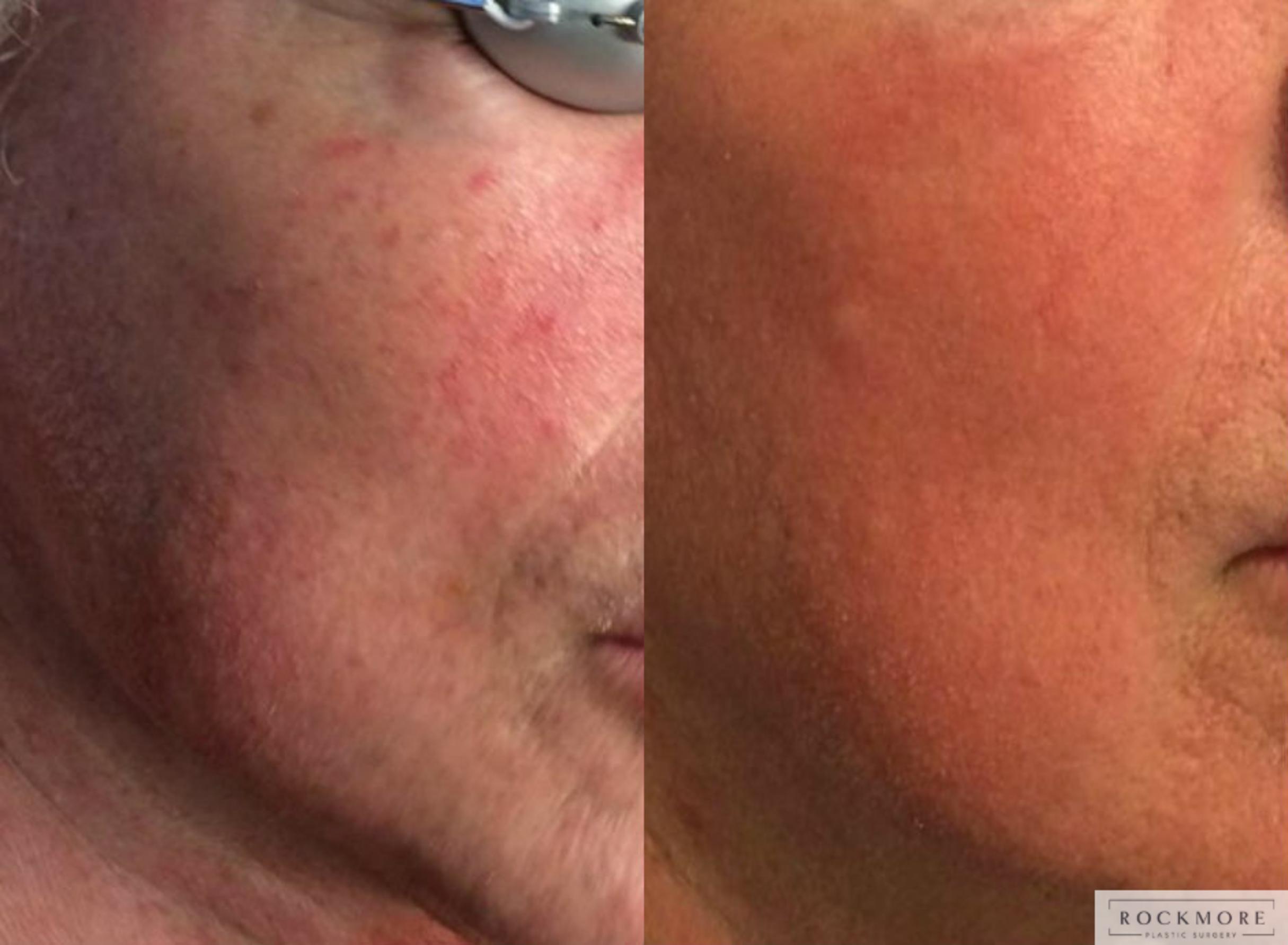Before & After Icon Laser Case 312 View #1 View in Albany & Latham, New York