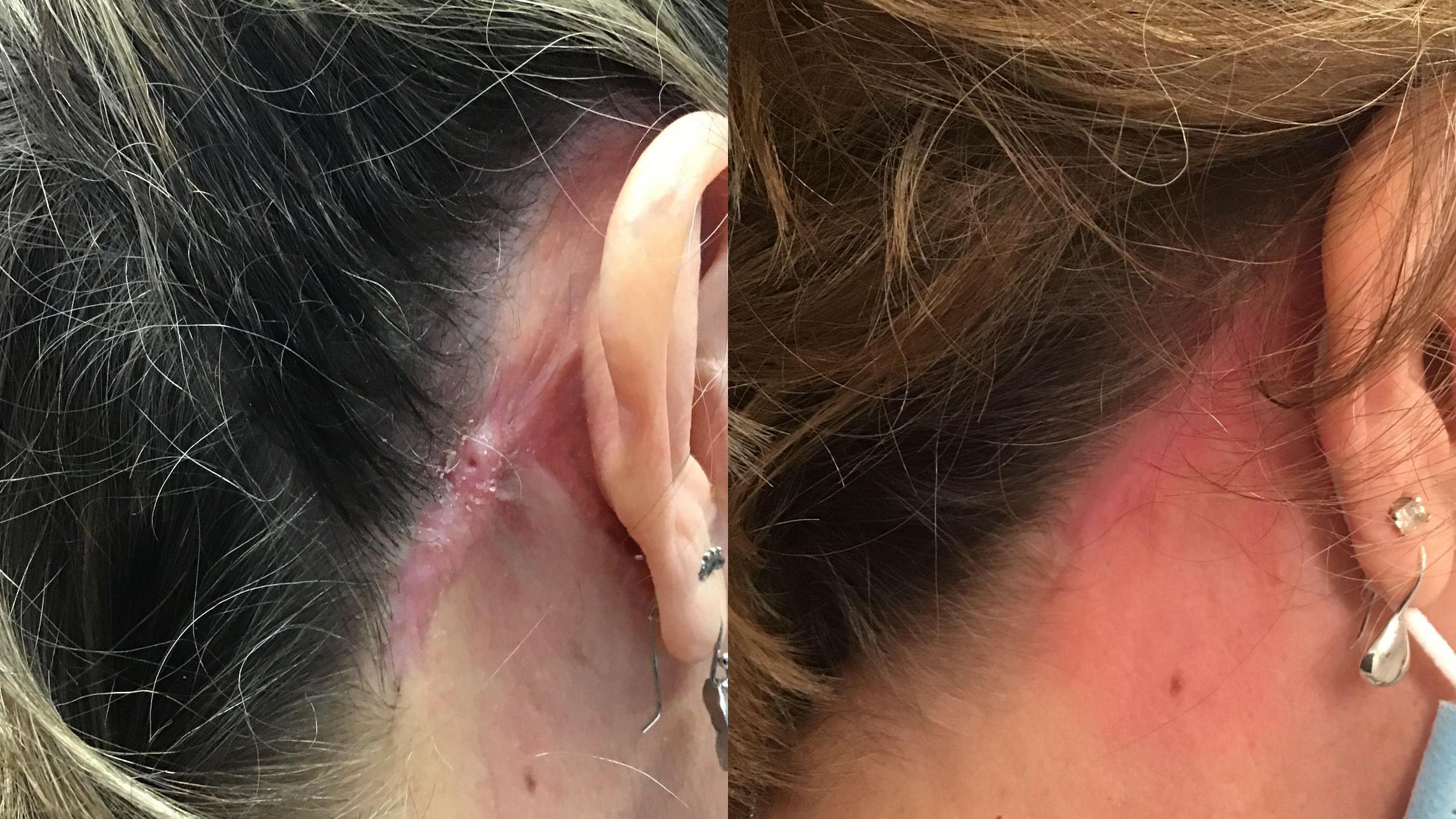 Before & After Icon Laser Case 345 Back View in Albany & Latham, New York