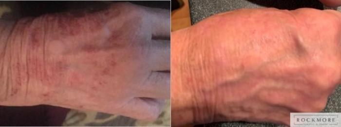 Before & After Icon Laser Case 346 Hand View in Albany & Latham, New York