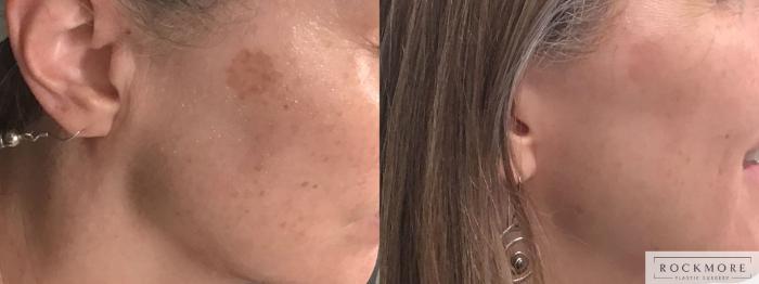 Before & After Icon Laser Case 399 Right Side View in Albany & Latham, New York