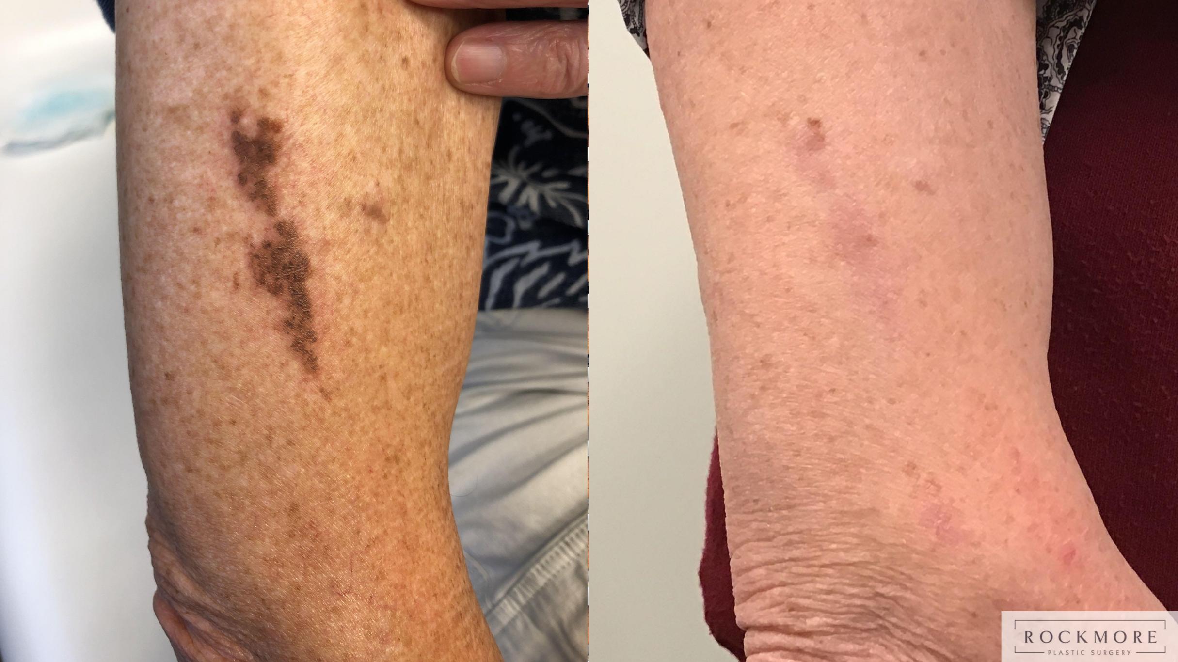Before & After Icon Laser Case 403 Right Side View in Albany & Latham, New York