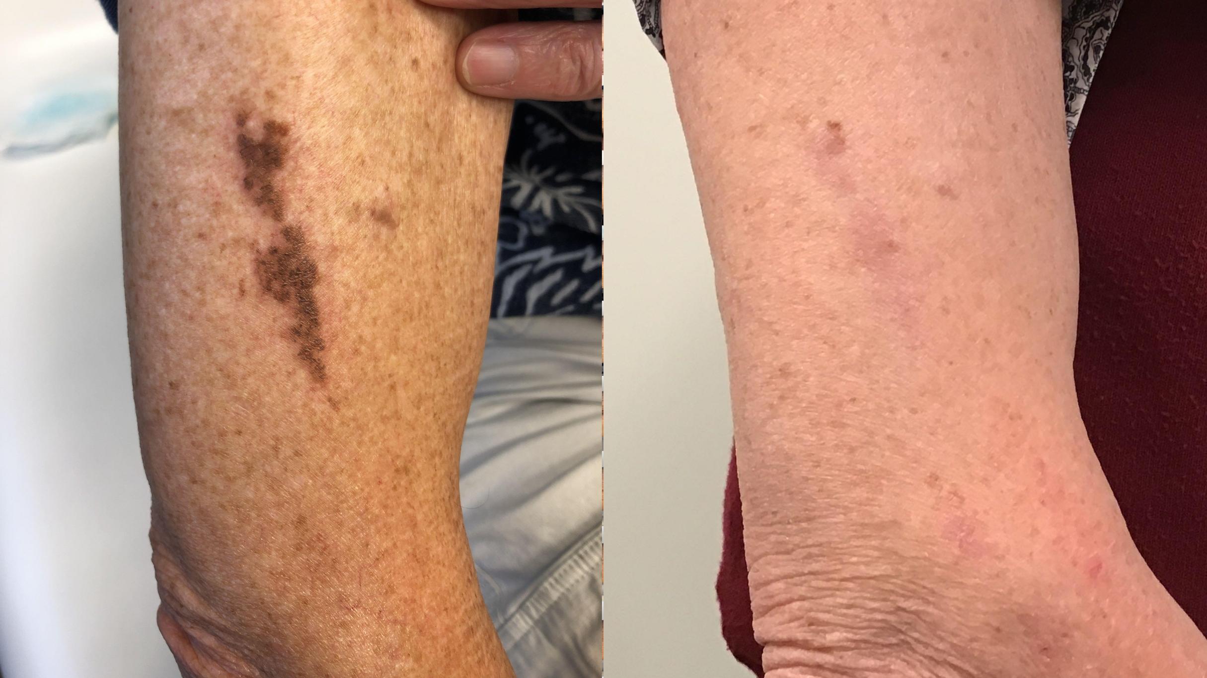 Before & After Icon Laser Case 403 Right Side View in Albany & Latham, New York