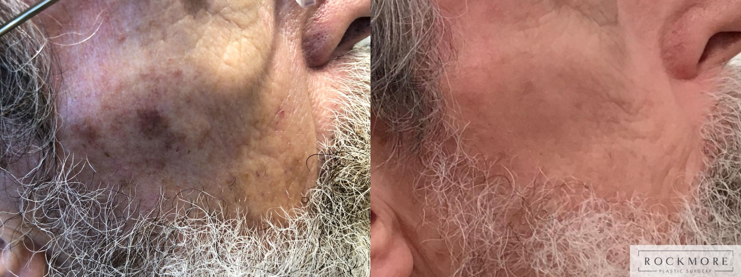 Before & After Icon Laser Case 404 Right Side View in Albany & Latham, New York