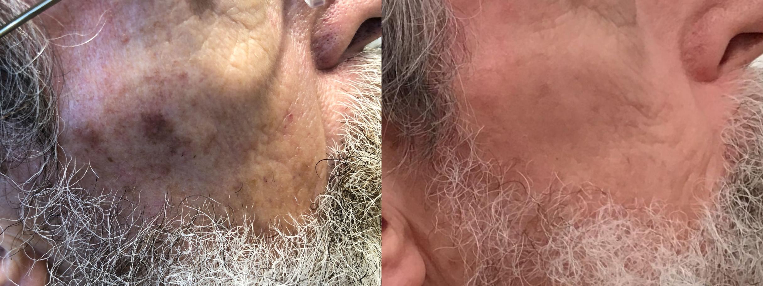 Before & After Icon Laser Case 404 Right Side View in Albany & Latham, New York