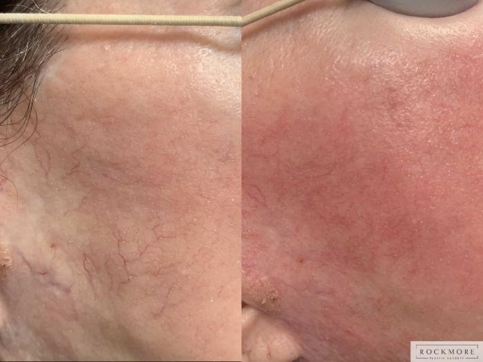Before & After Icon Laser Case 425 Right Side View in Albany & Latham, New York