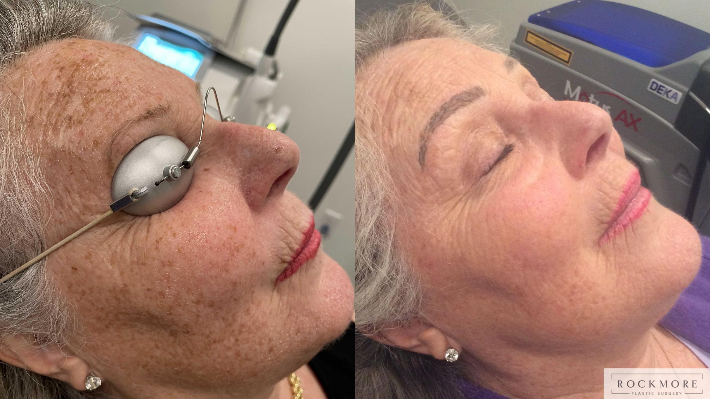 Before & After Icon Laser Case 430 Right Side View in Albany & Latham, New York
