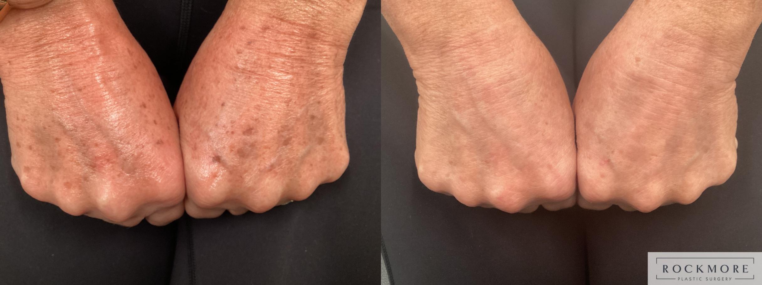 Before & After Icon Laser Case 461 Hands View in Albany & Latham, New York
