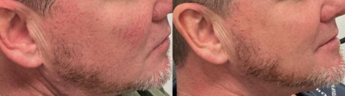 Before & After Icon Laser Case 503 Right Side View in Albany, Latham & Saratoga, New York