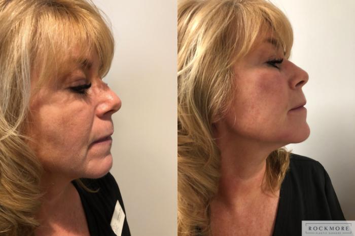 Before & After Injectable Fillers Case 296 View #1 View in Albany & Latham, New York