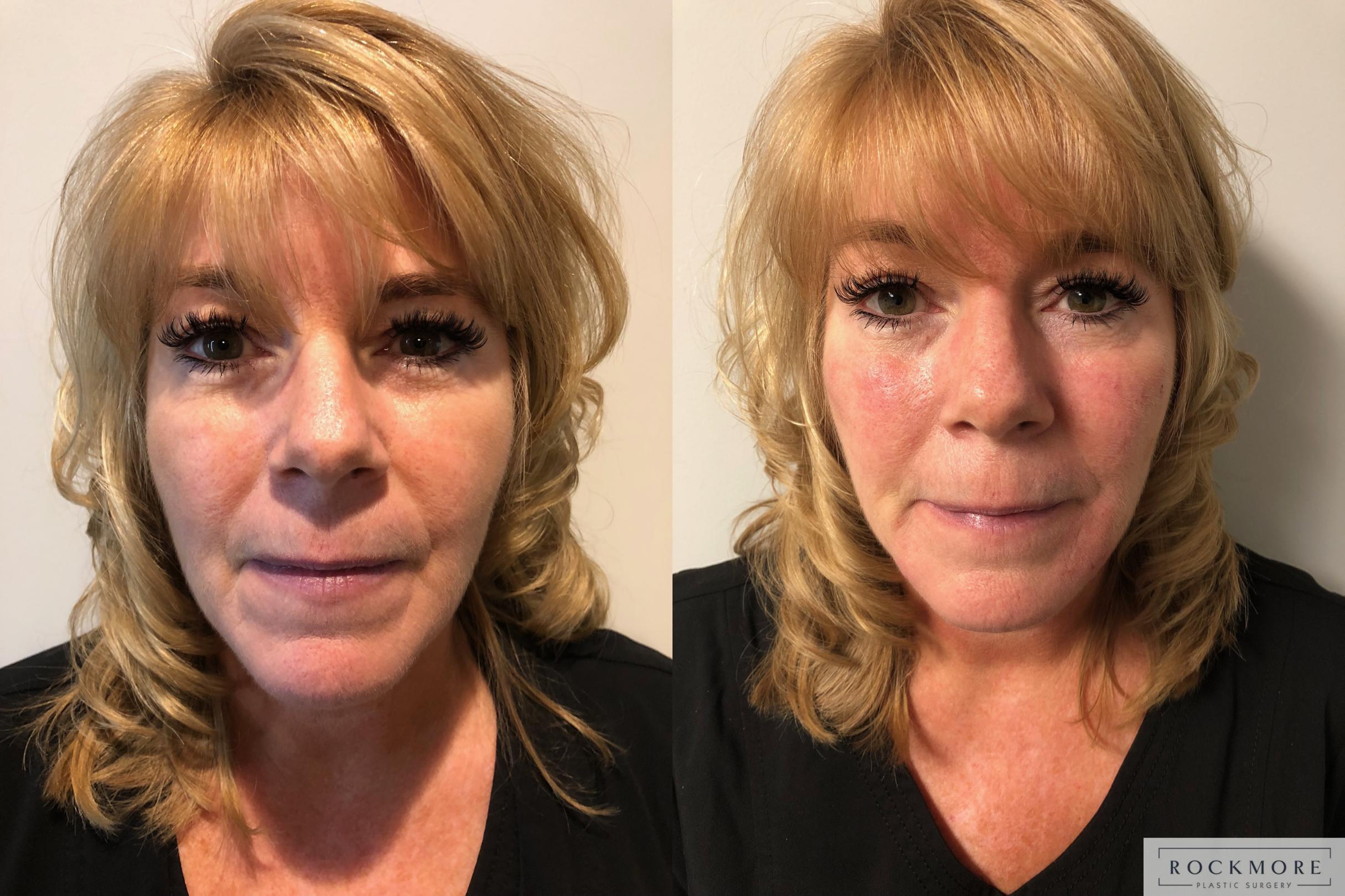 Before & After Injectable Fillers Case 296 View #2 View in Albany, Latham & Saratoga, New York