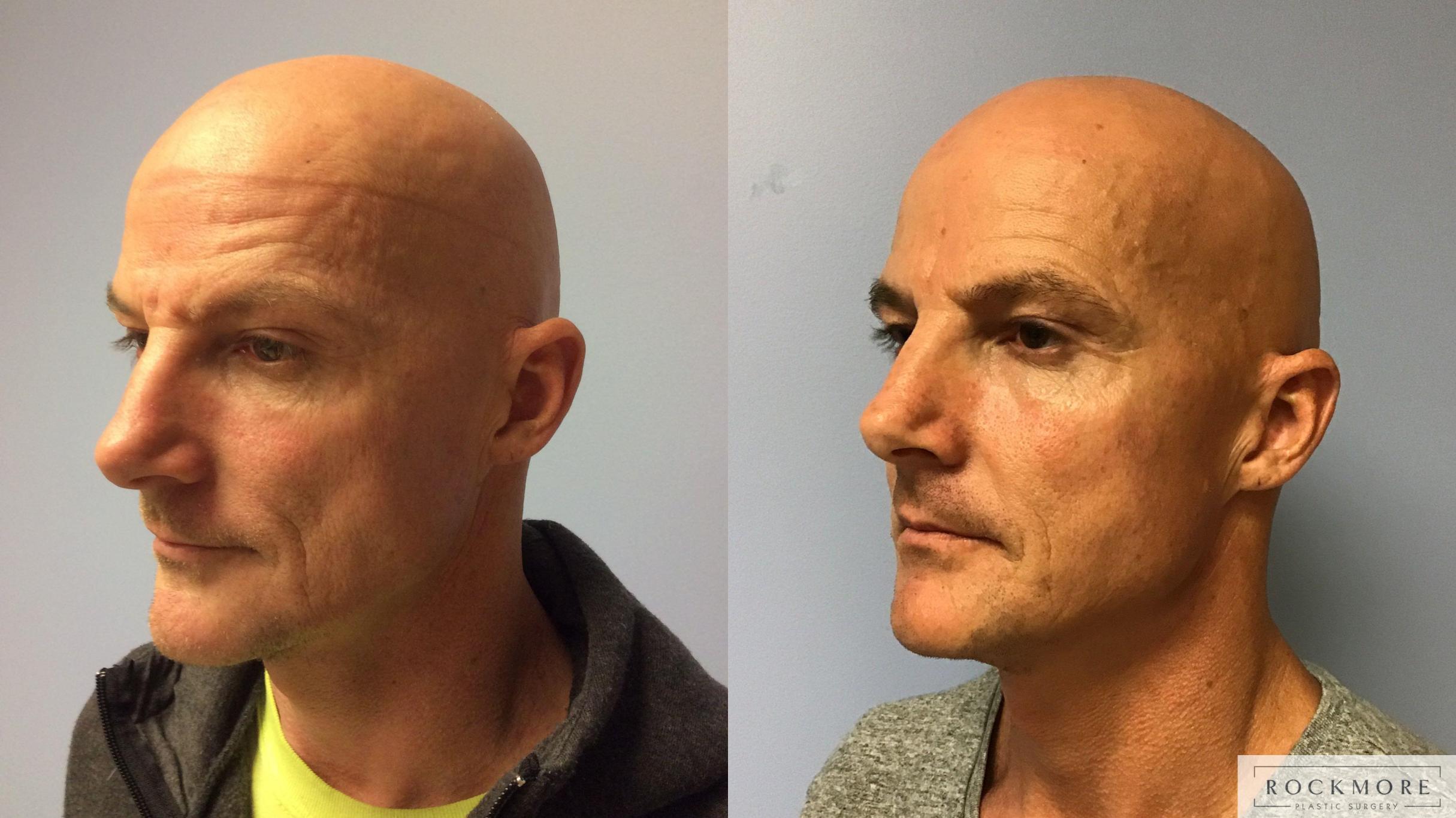 Before & After Injectable Fillers Case 351 Left Oblique View in Albany & Latham, New York