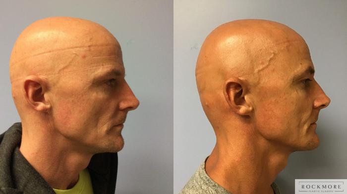 Before & After Injectable Fillers Case 351 Right Side View in Albany & Latham, New York