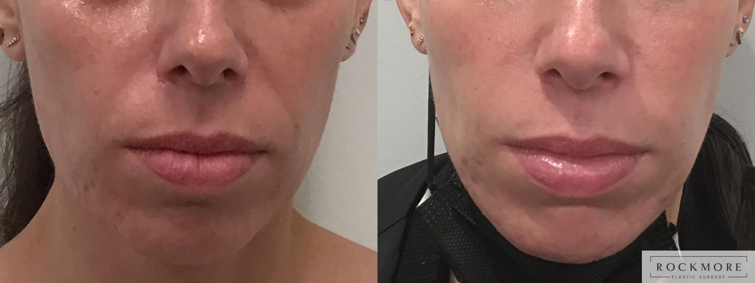 Before & After Injectable Fillers Case 400 Front View in Albany & Latham, New York