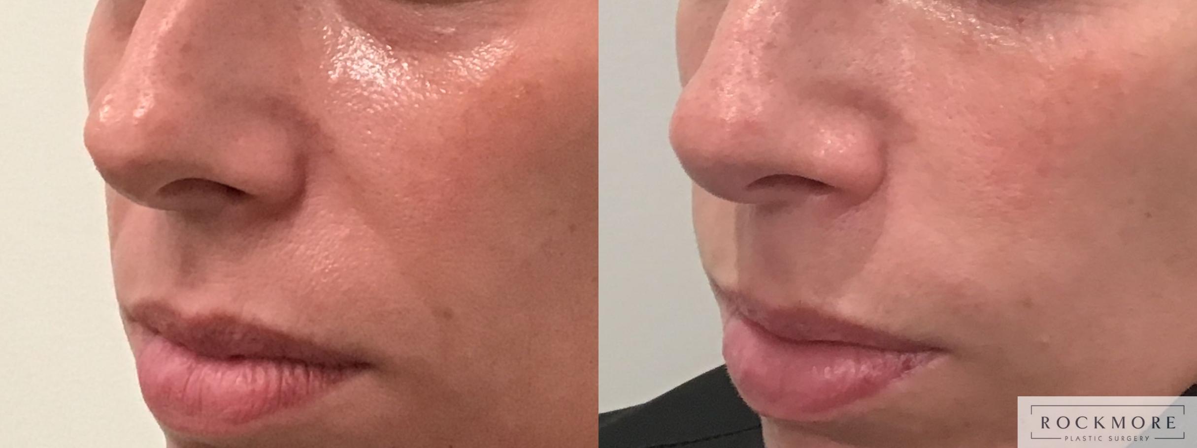 Before & After Injectable Fillers Case 400 Left Side View in Albany & Latham, New York