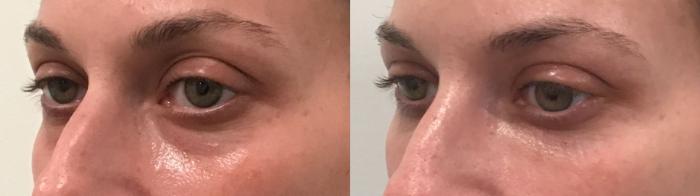 Before & After Injectable Fillers Case 401 Left Oblique View in Albany, Latham & Saratoga, New York