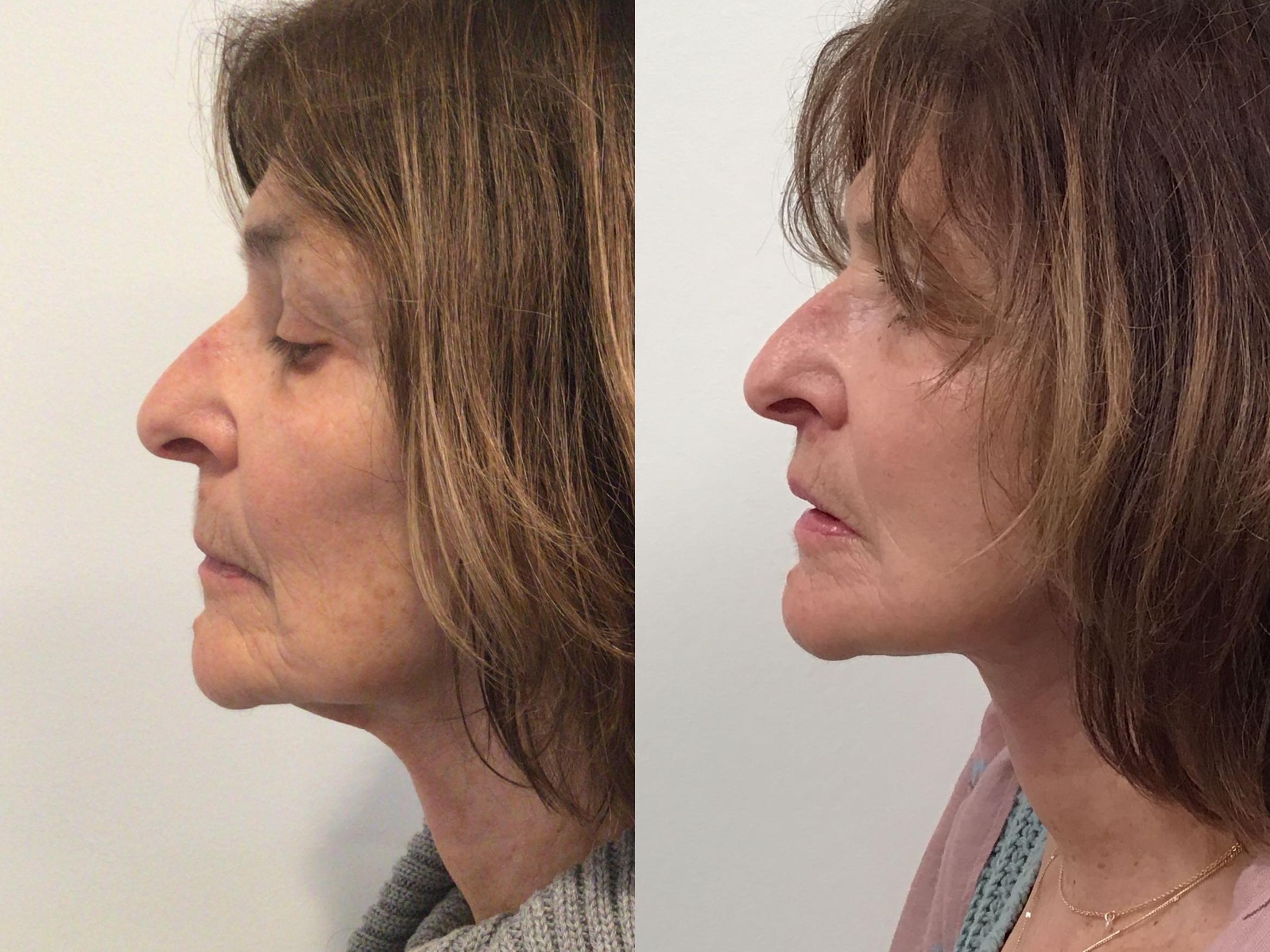 Before & After Neck Lift Case 408 Right Side View in Albany & Latham, New York