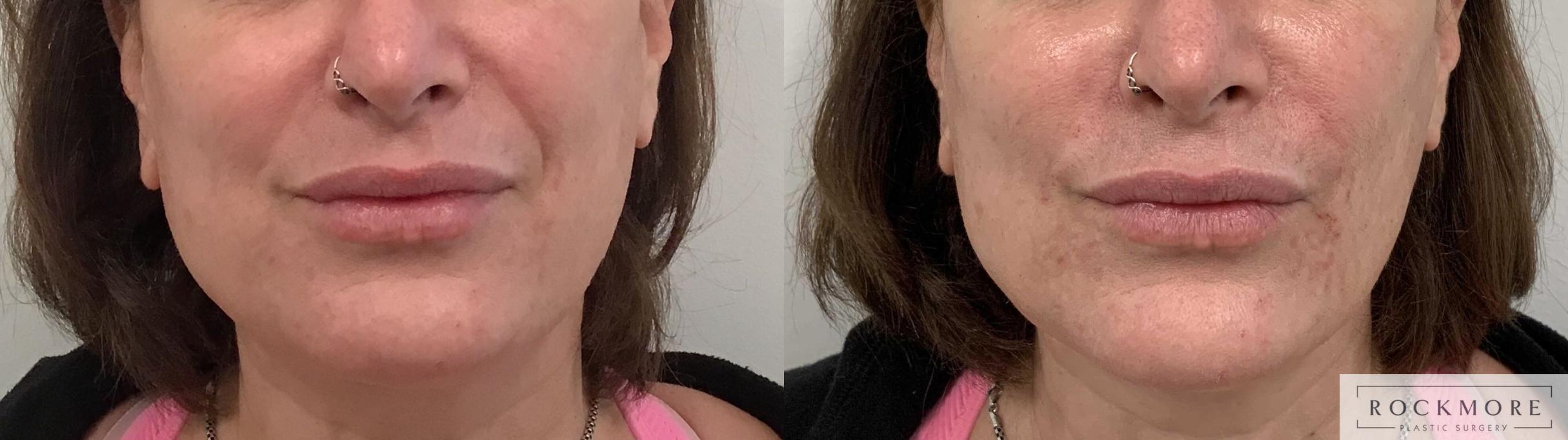 Before & After Injectable Fillers Case 417 Left Side View in Albany & Latham, New York