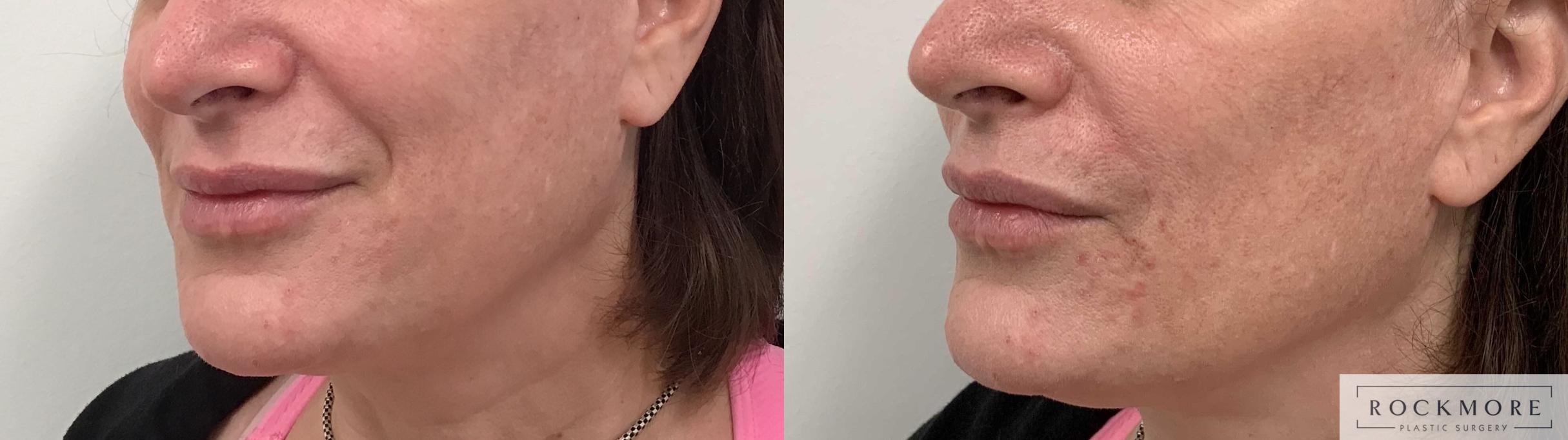 Before & After Injectable Fillers Case 417 Right Side View in Albany & Latham, New York