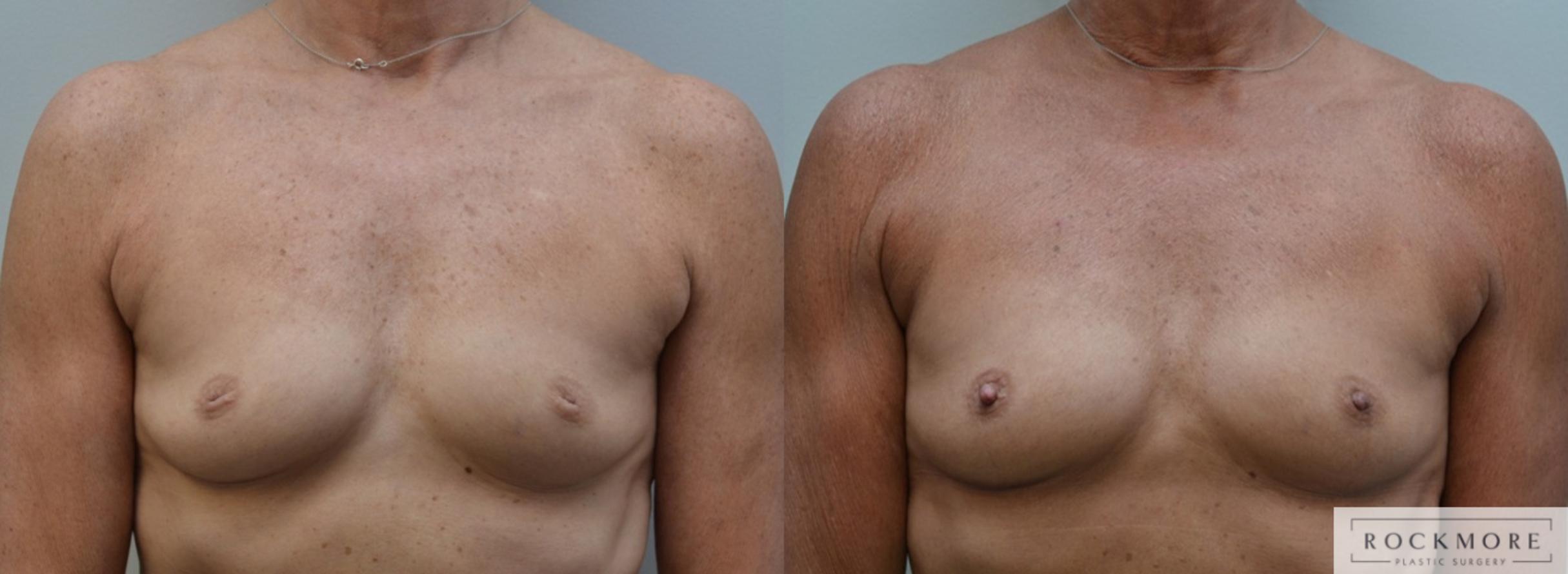Before & After Inverted Nipples Case 193 View #1 View in Albany & Latham, New York