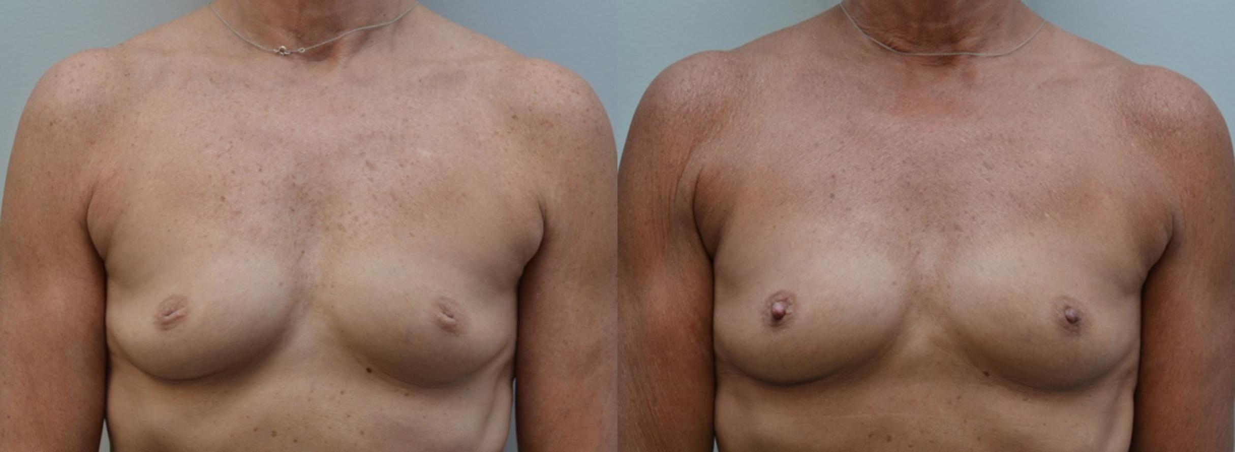 Before & After Inverted Nipples Case 193 View #1 View in Albany & Latham, New York