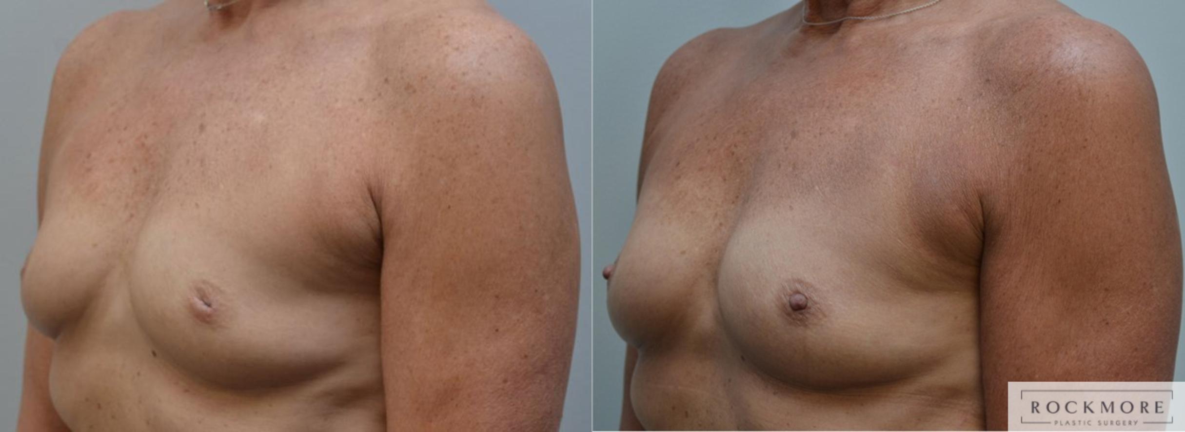 Before & After Inverted Nipples Case 193 View #2 View in Albany & Latham, New York
