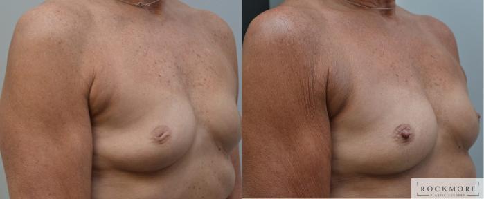 Before & After Inverted Nipples Case 193 View #3 View in Albany & Latham, New York