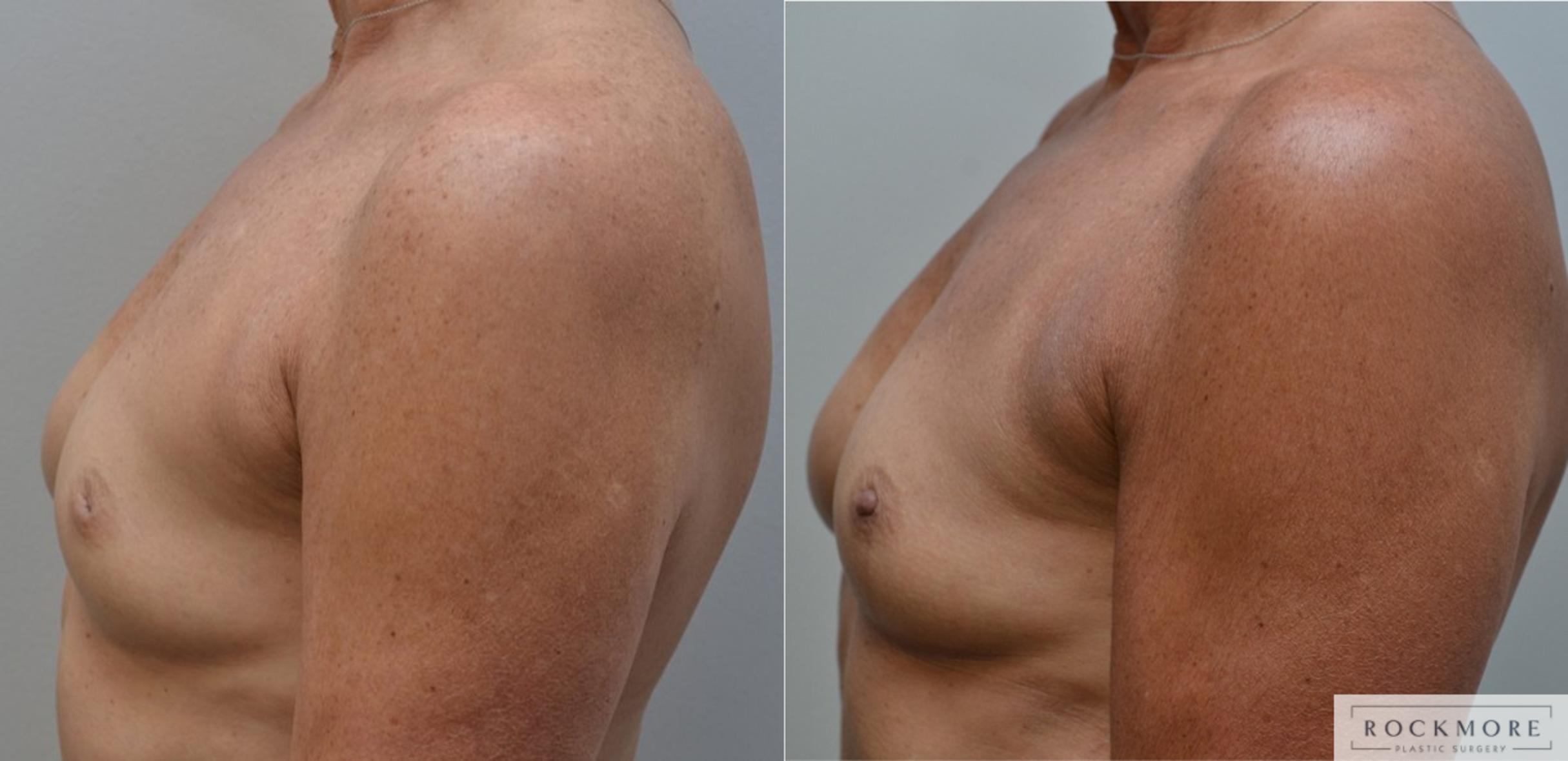 Before & After Inverted Nipples Case 193 View #4 View in Albany & Latham, New York