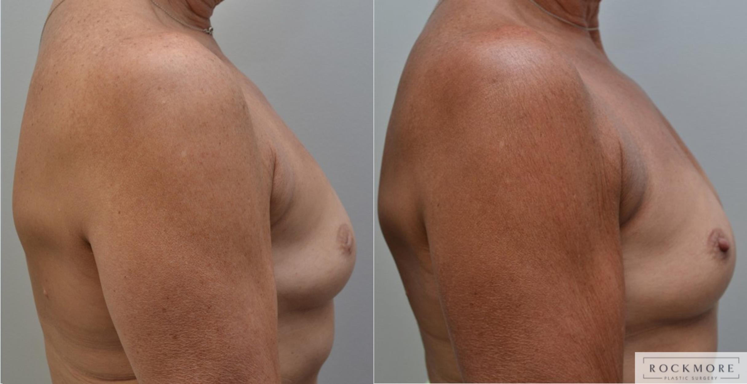 Before & After Inverted Nipples Case 193 View #5 View in Albany & Latham, New York