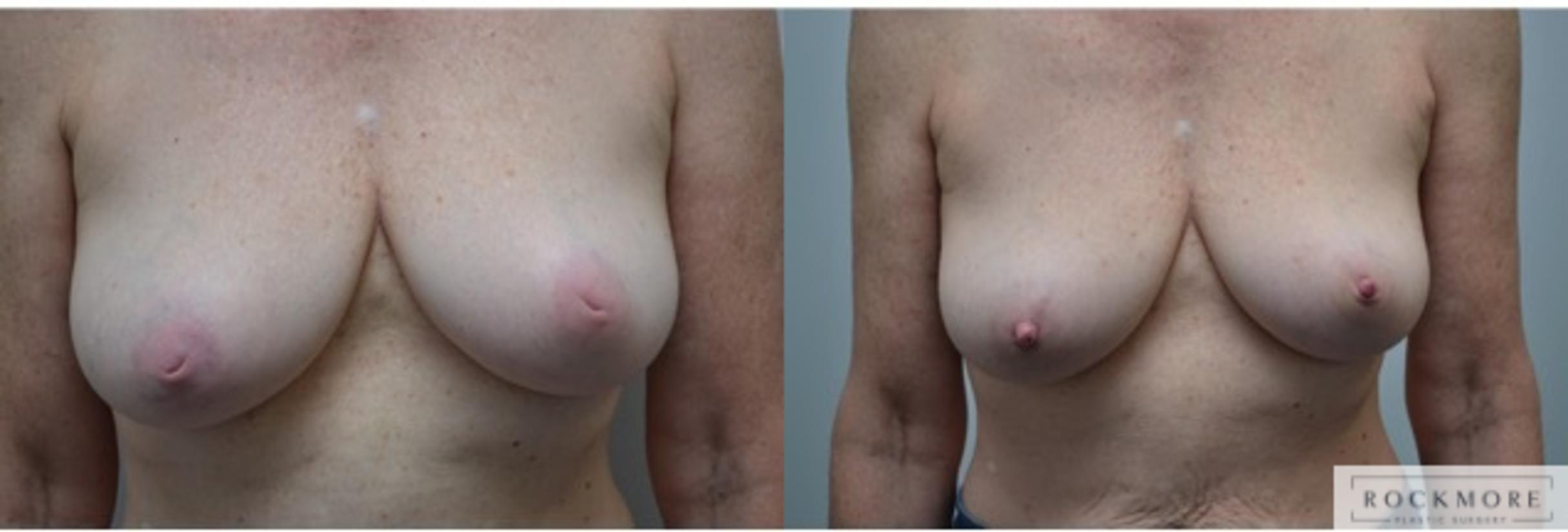 Before & After Inverted Nipples Case 276 View #1 View in Albany & Latham, New York