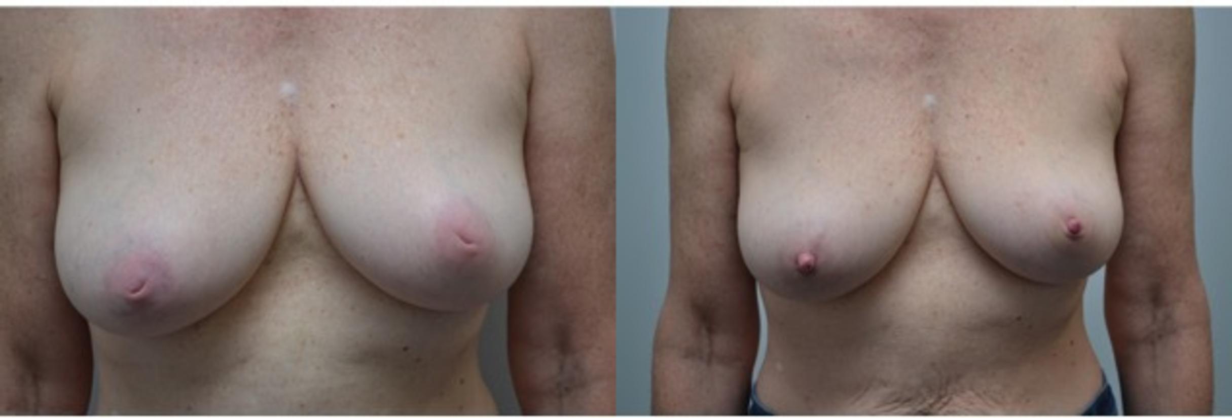 Before & After Inverted Nipples Case 276 View #1 View in Albany, Latham & Saratoga, New York