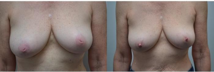 Before & After Inverted Nipples Case 276 View #1 View in Albany & Latham, New York