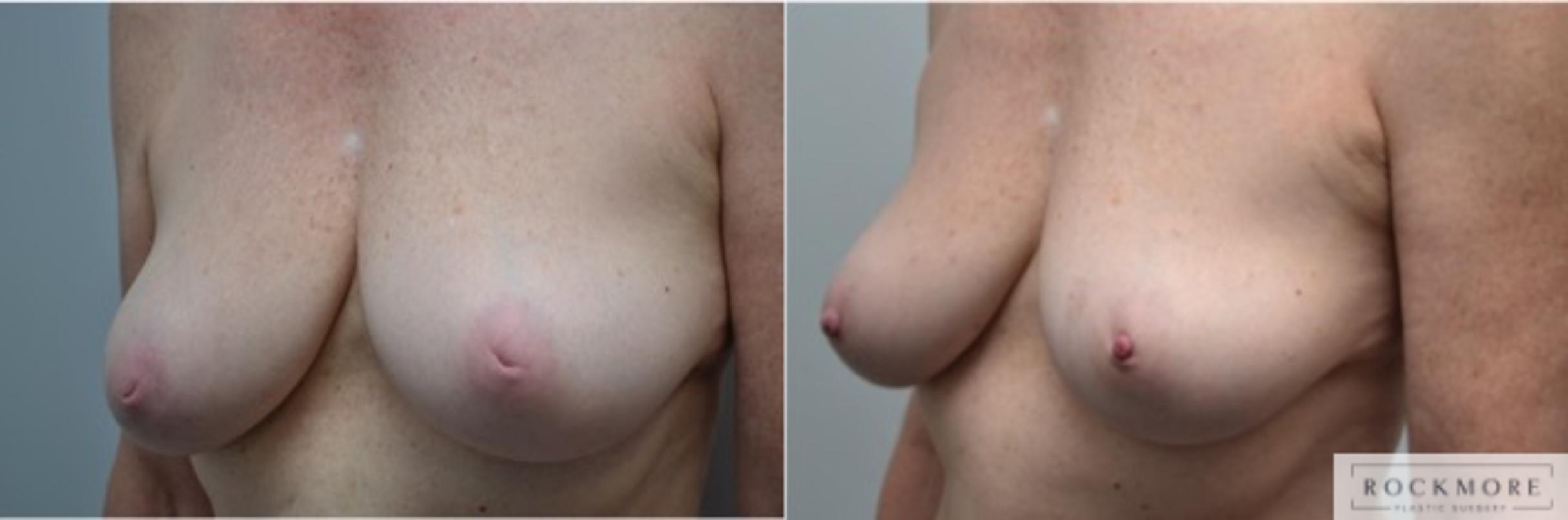 Before & After Inverted Nipples Case 276 View #2 View in Albany & Latham, New York