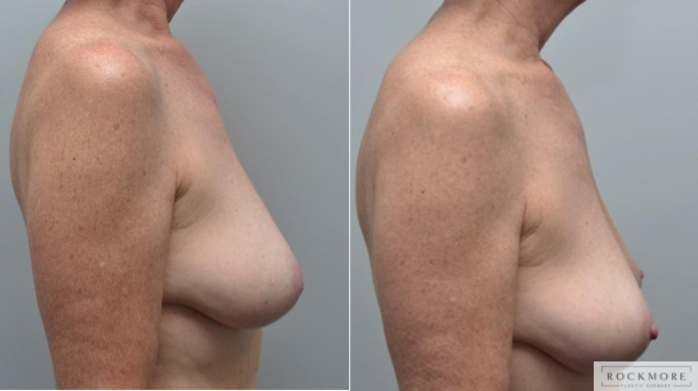 Before & After Inverted Nipples Case 276 View #3 View in Albany & Latham, New York