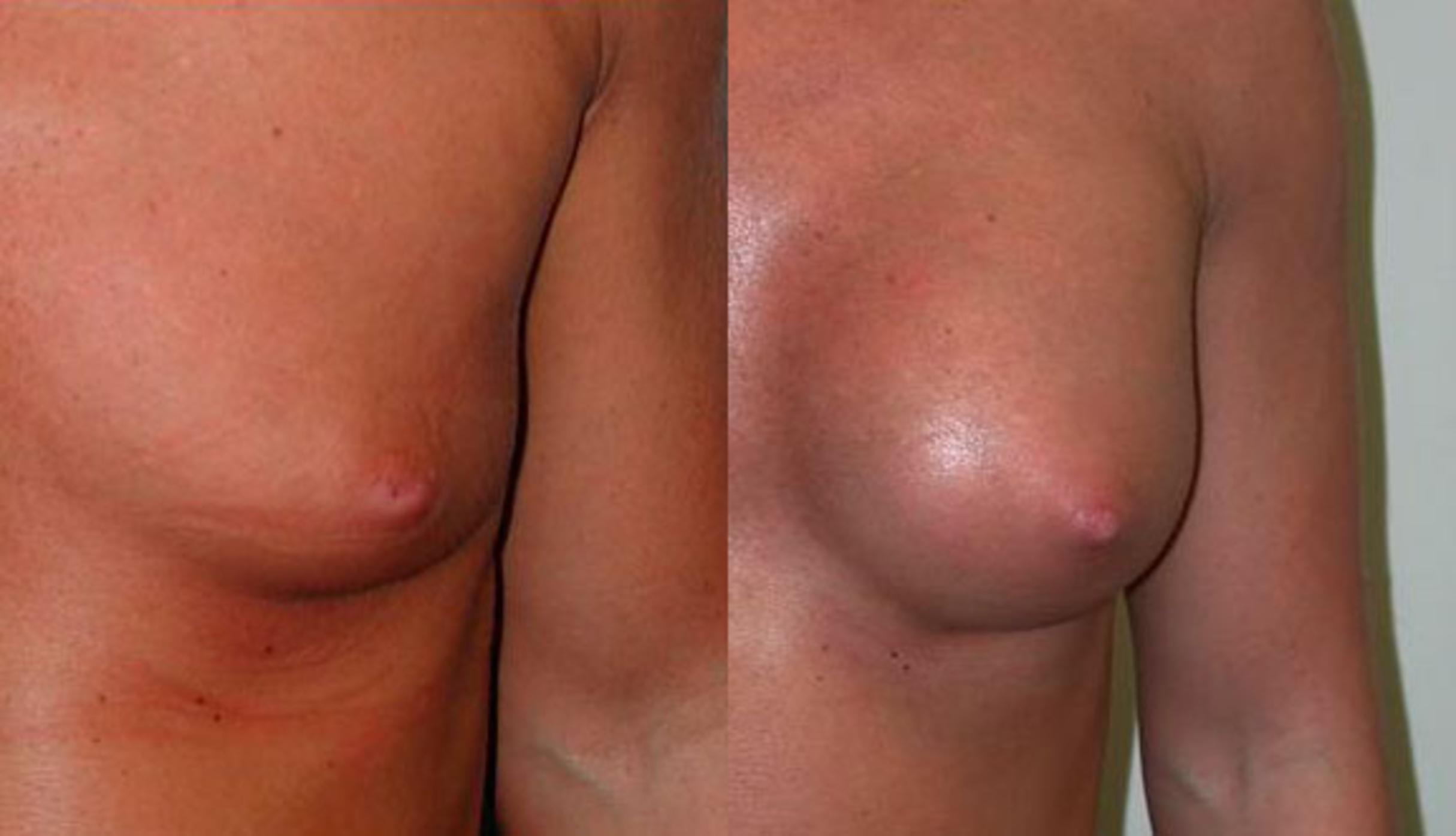 Before & After Inverted Nipples Case 74 View #1 View in Albany, Latham & Saratoga, New York