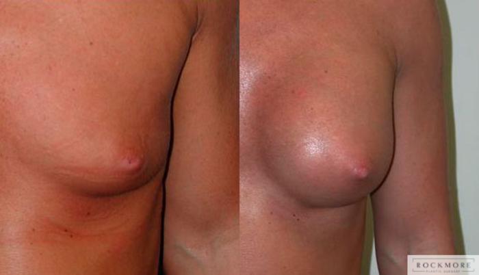 Before & After Inverted Nipples Case 74 View #1 View in Albany & Latham, New York