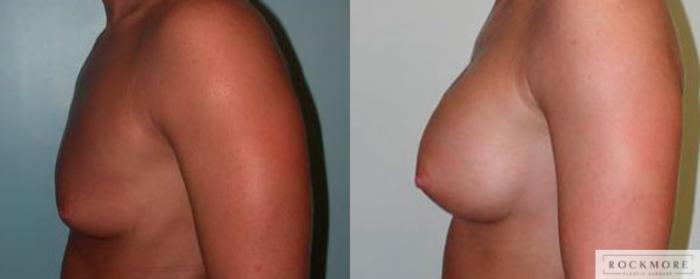 Before & After Inverted Nipples Case 74 View #2 View in Albany & Latham, New York
