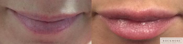 Before & After Lip Augmentation Case 300 View #1 View in Albany & Latham, New York