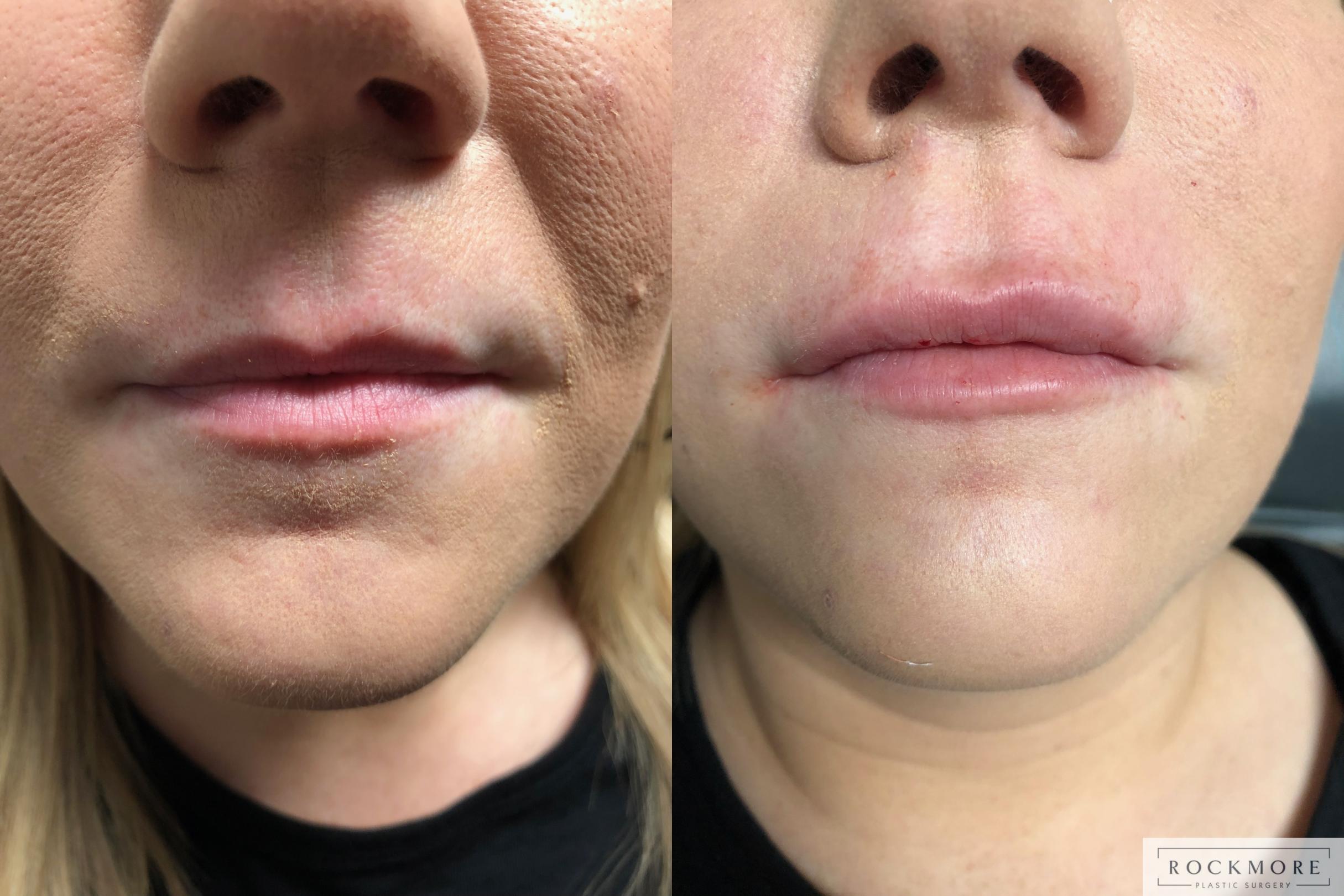 Before & After Lip Augmentation Case 304 View #1 View in Albany & Latham, New York