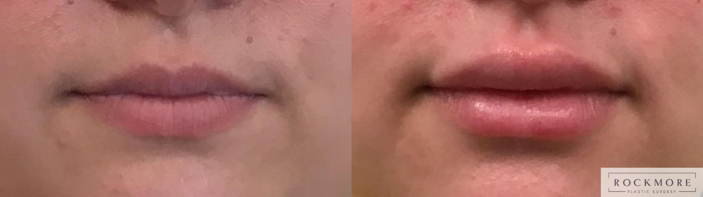 Before & After Lip Augmentation Case 331 Front View in Albany & Latham, New York
