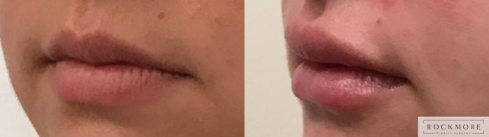 Before & After Lip Augmentation Case 331 Left Oblique View in Albany & Latham, New York