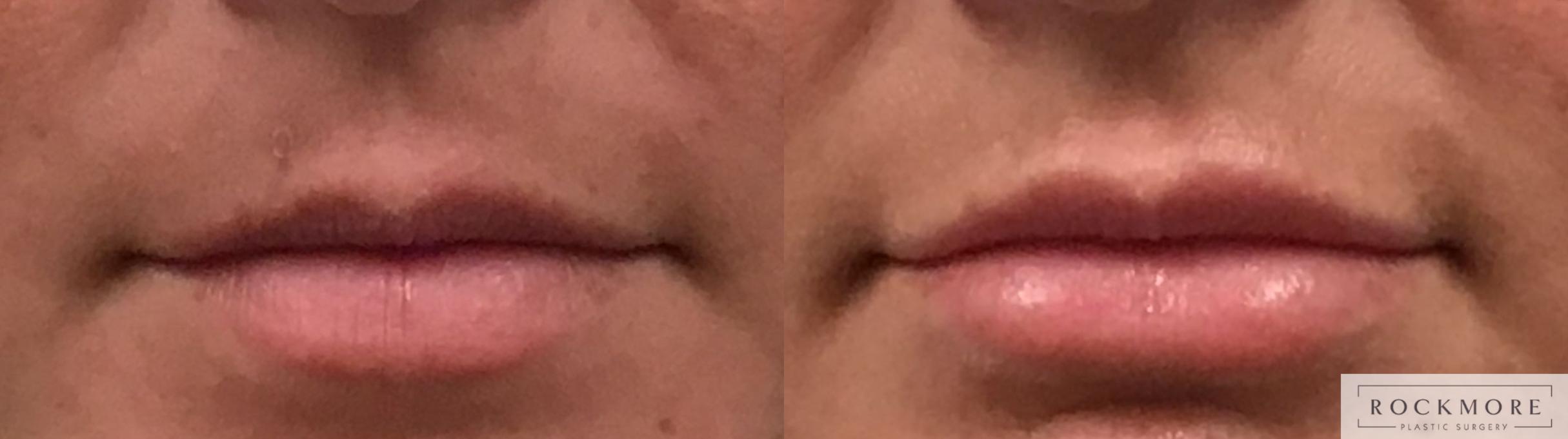 Before & After Lip Augmentation Case 332 Front View in Albany & Latham, New York