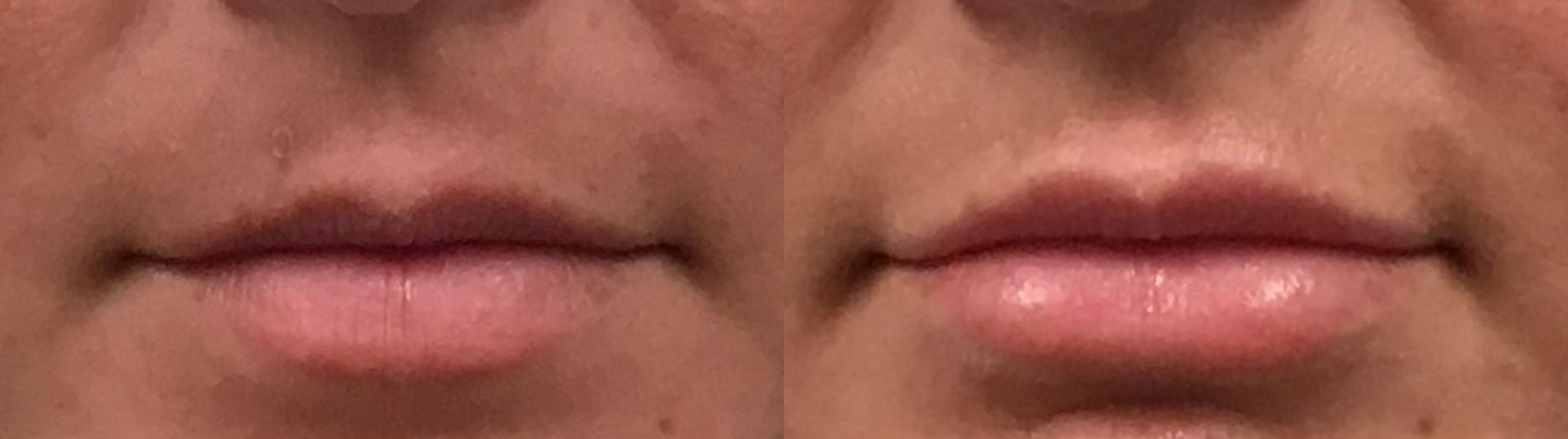 Before & After Lip Augmentation Case 332 Front View in Albany, Latham & Saratoga, New York