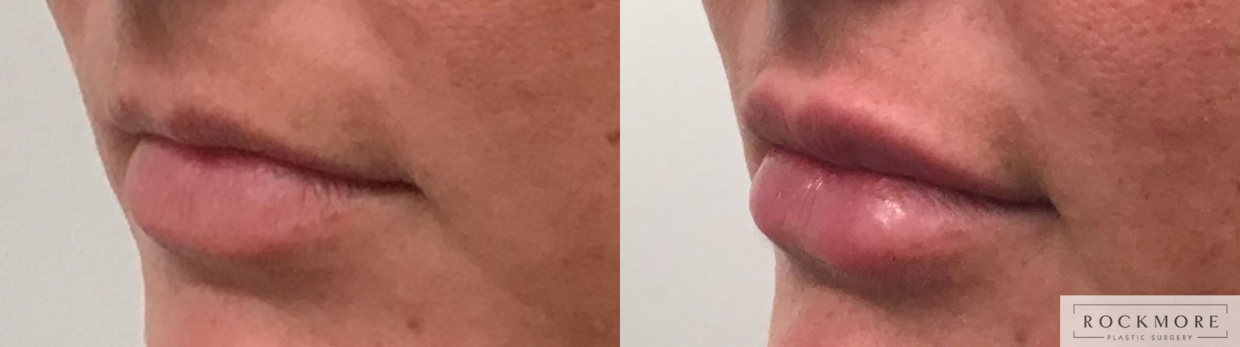 Before & After Lip Augmentation Case 332 Left Oblique View in Albany & Latham, New York