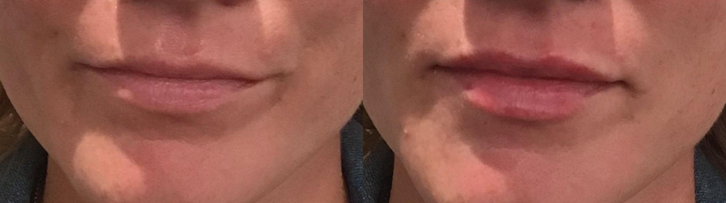 Before & After Lip Augmentation Case 334 Front View in Albany & Latham, New York